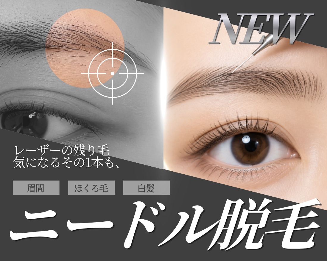 ≪NEW≫ ニードル脱毛（医療針脱毛／絶縁針脱毛）導入【大阪・心斎橋院